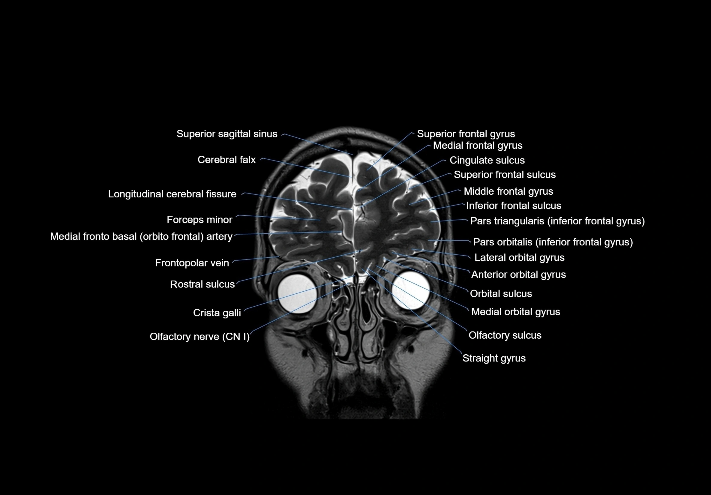 MRI Brain coronal cross sectional labelled anatomy 3T image  -img-00001-00013.webp
